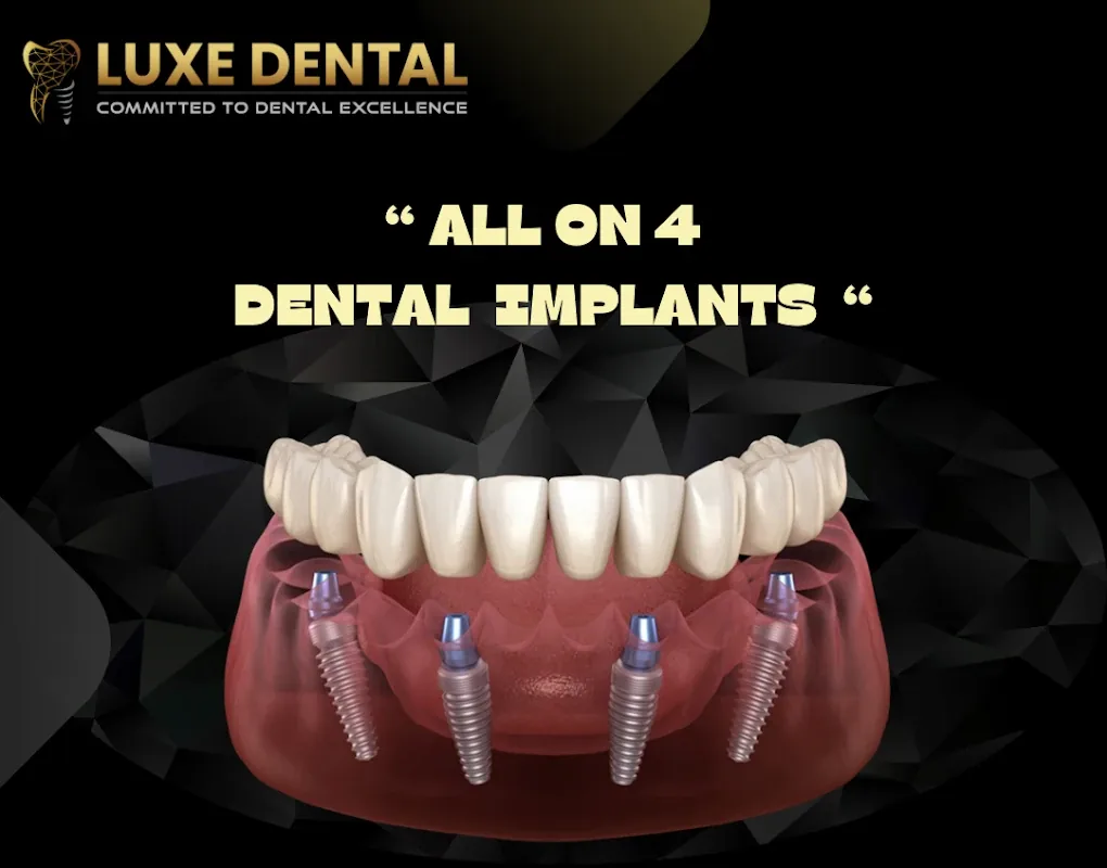 Illustration of All-on-4 dental implants: a full arch of fixed teeth held by four implants