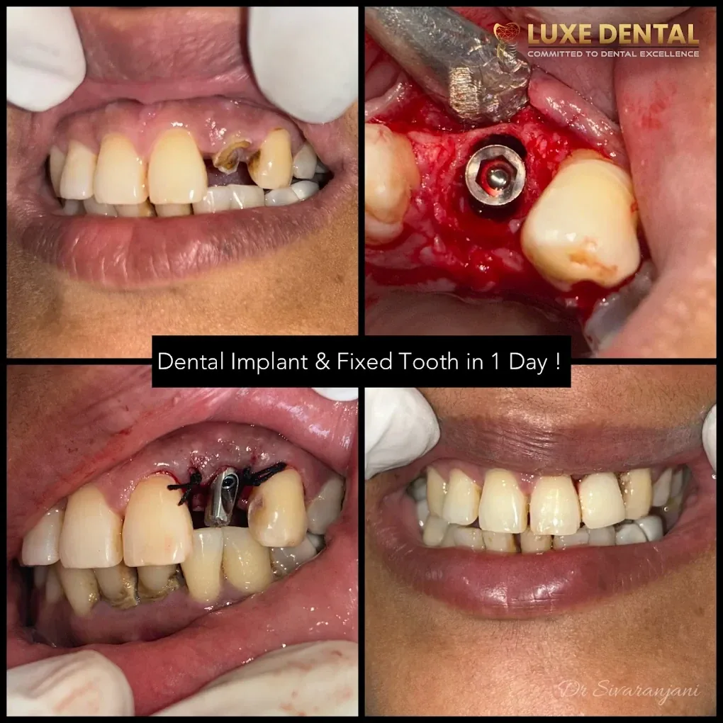 Front tooth replaced with a dental implant at Luxe Dental Clinic: broken tooth, implant placed, stitches, then the fixed tooth