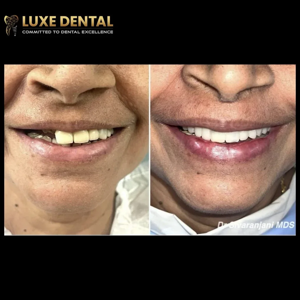 Before and after smile of a patient treated with dental implants by Dr. Sivaranjani at Luxe Dental Clinic, Velachery