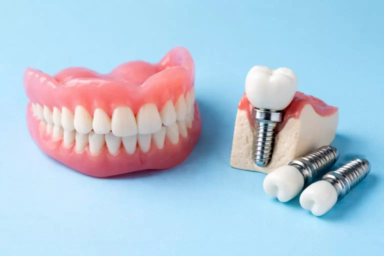 Dentures vs Dental Implants: Which Is Better for Your Everyday Life?